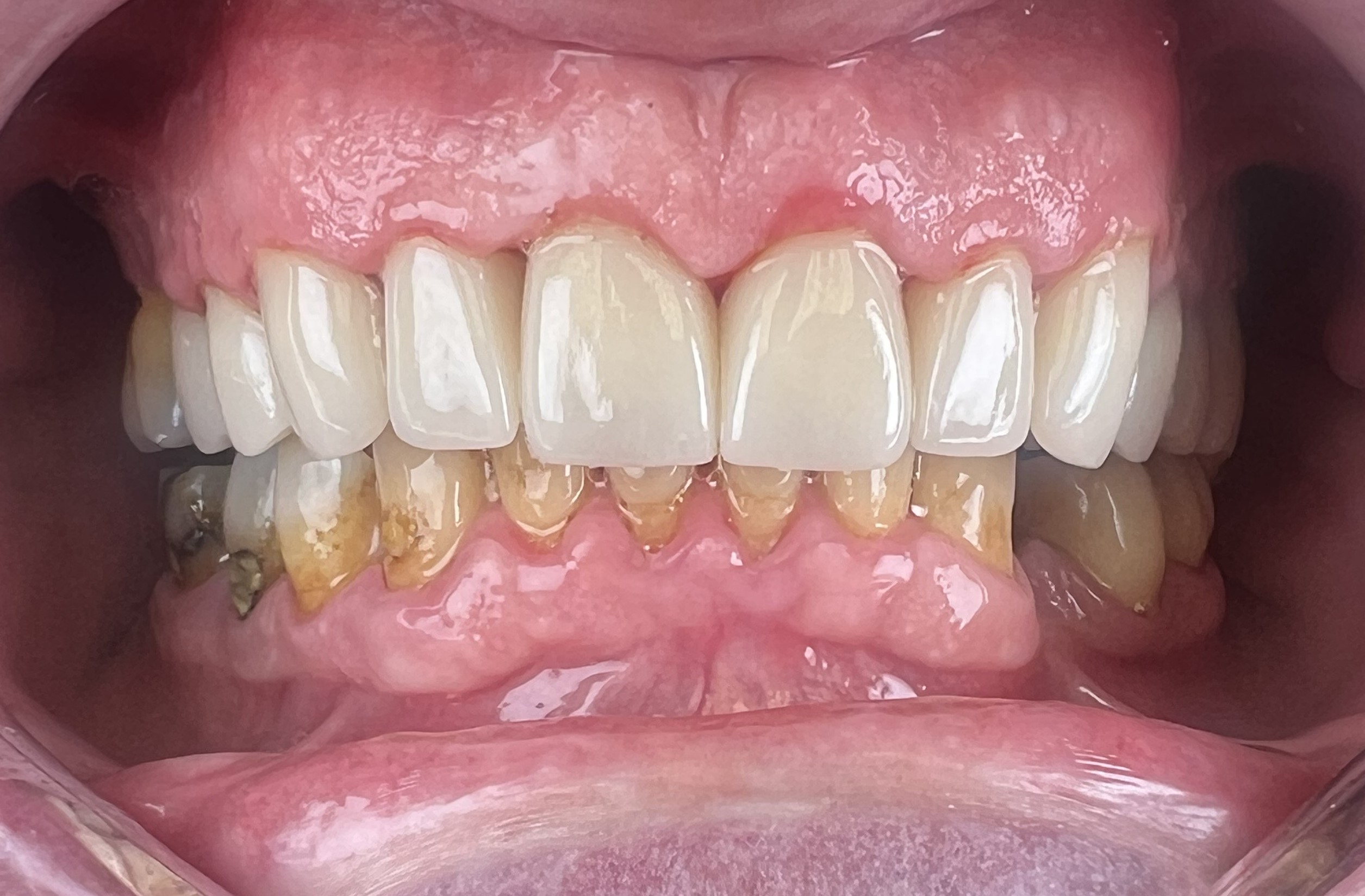 Case 1 after smile transformation