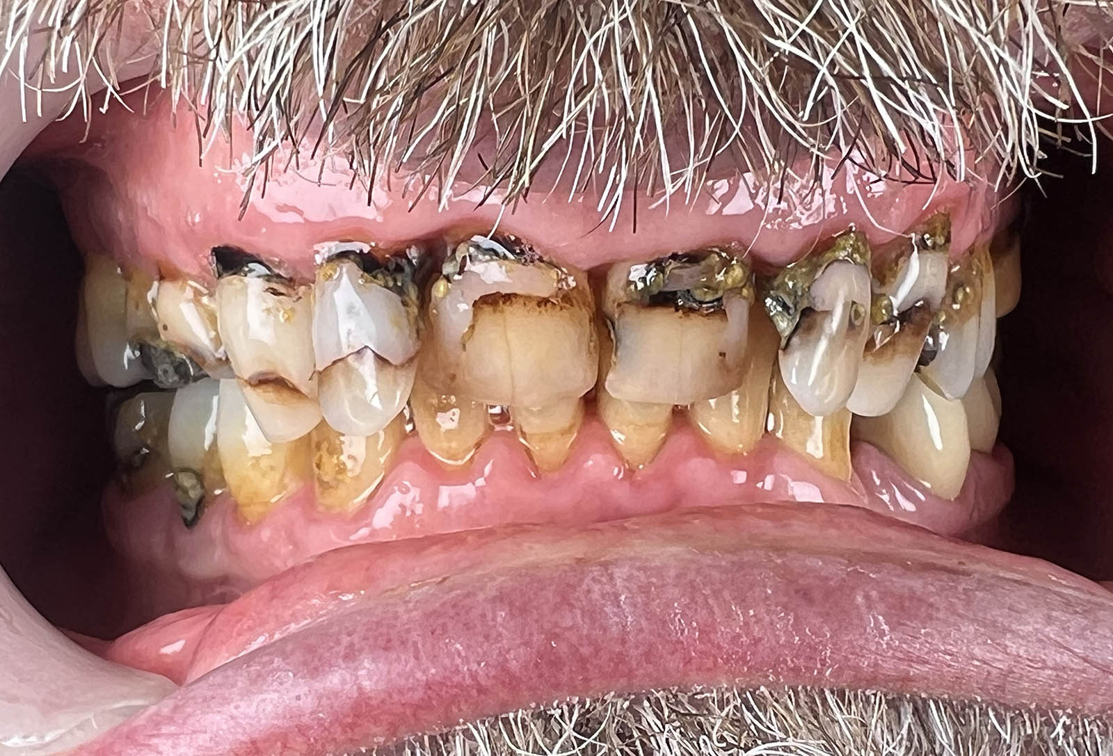 Case 1 before smile transformation