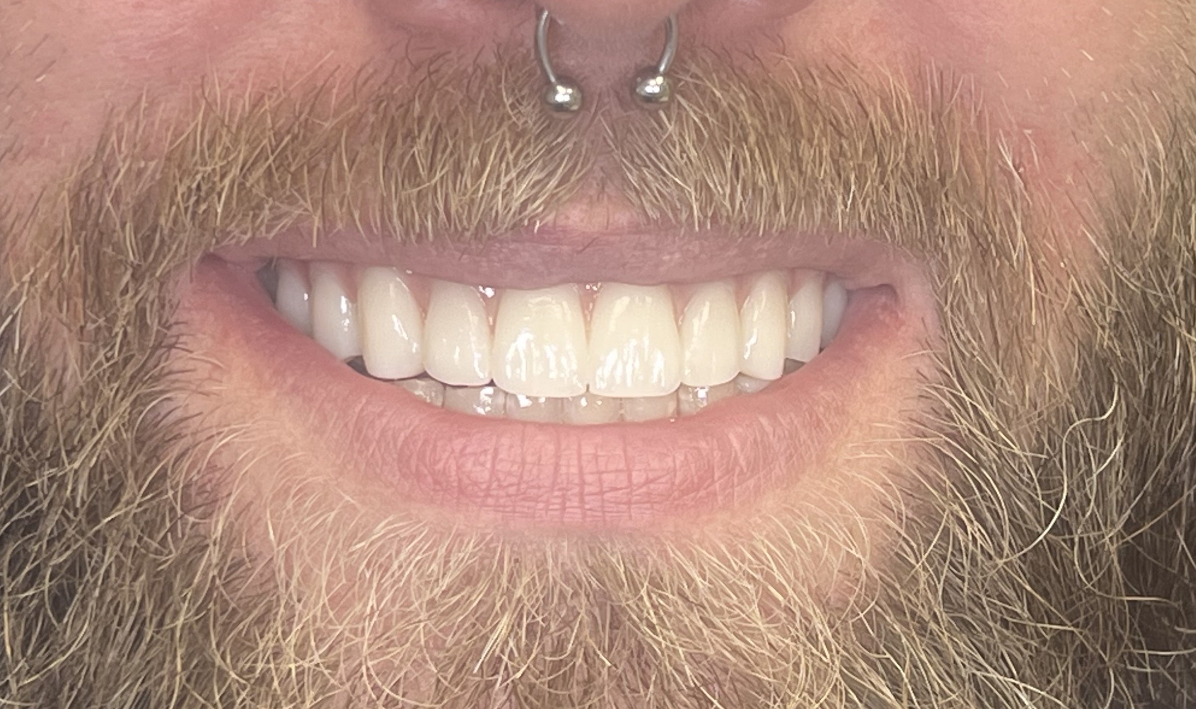 Case 2 after smile transformation