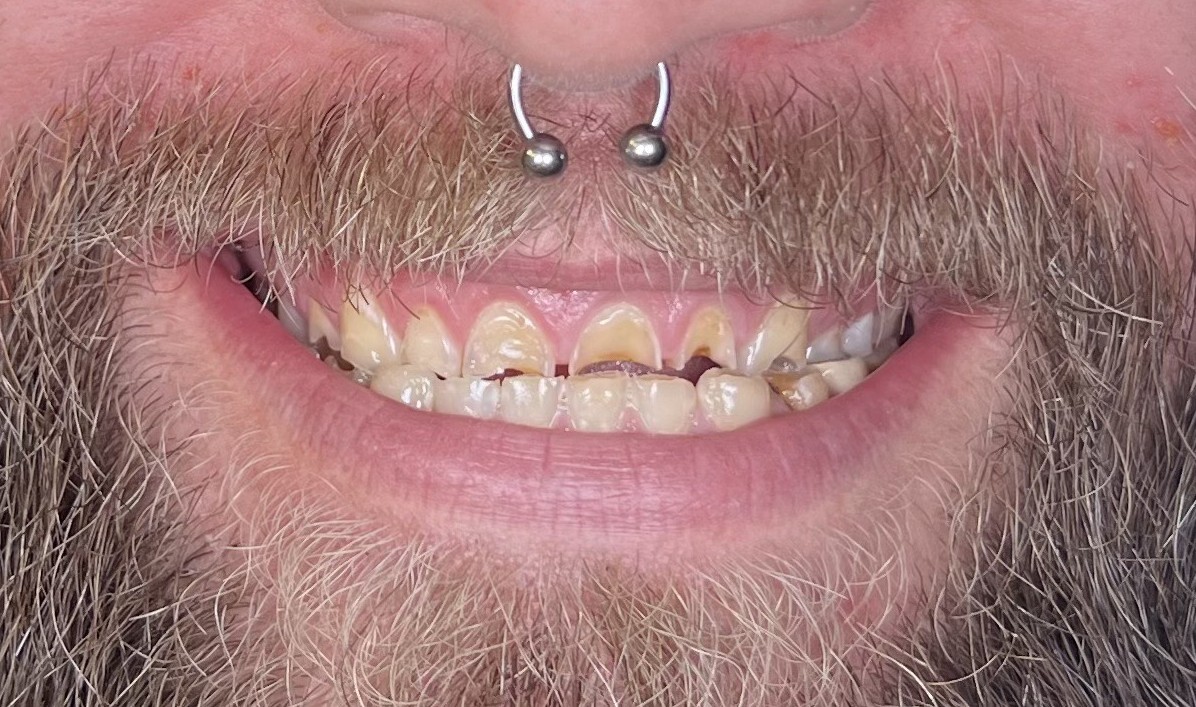 Case 2 before smile transformation