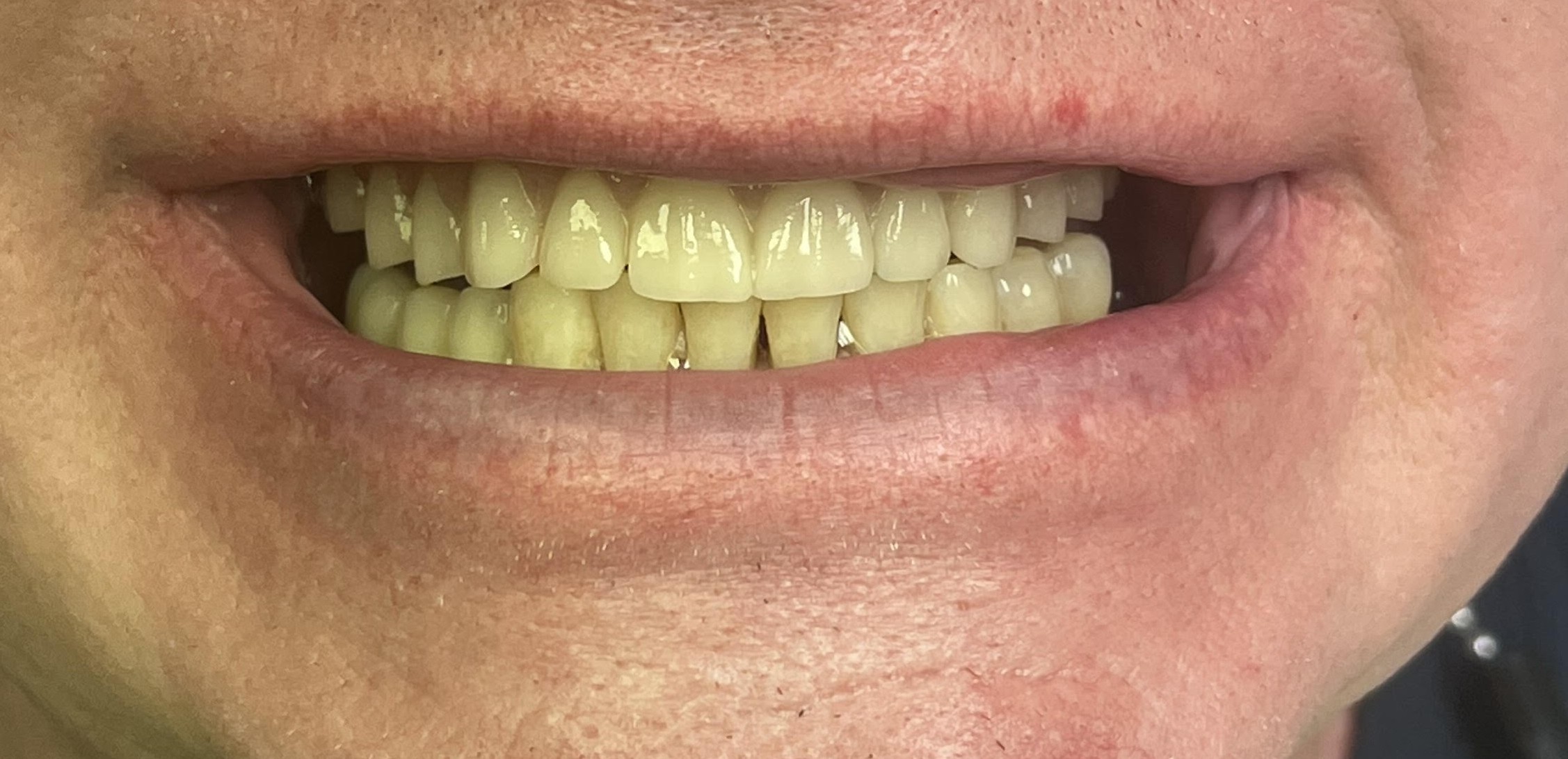 Case 3 after smile transformation