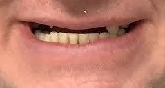 Case 3 before smile transformation