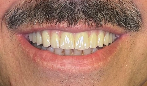 Case 4 after smile transformation