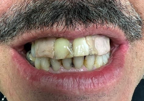Case 4 before smile transformation