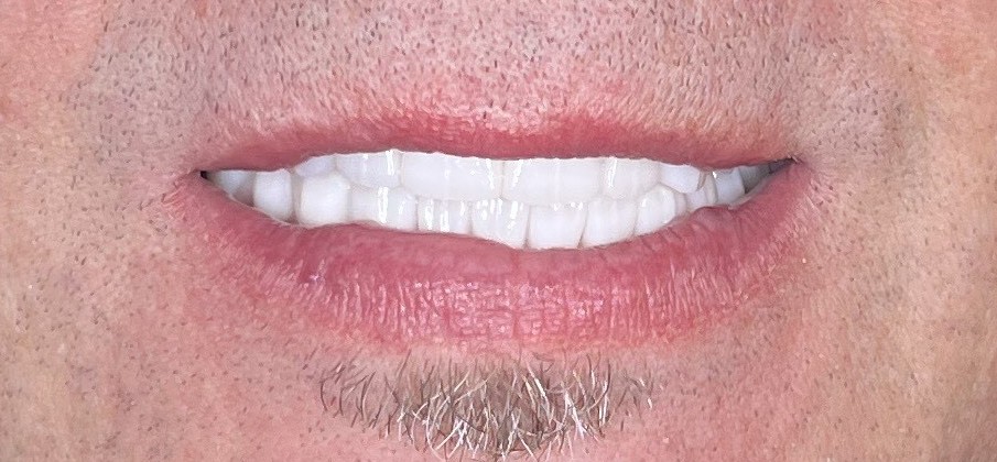 Case 5 after smile transformation