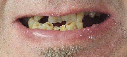 Case 5 before smile transformation