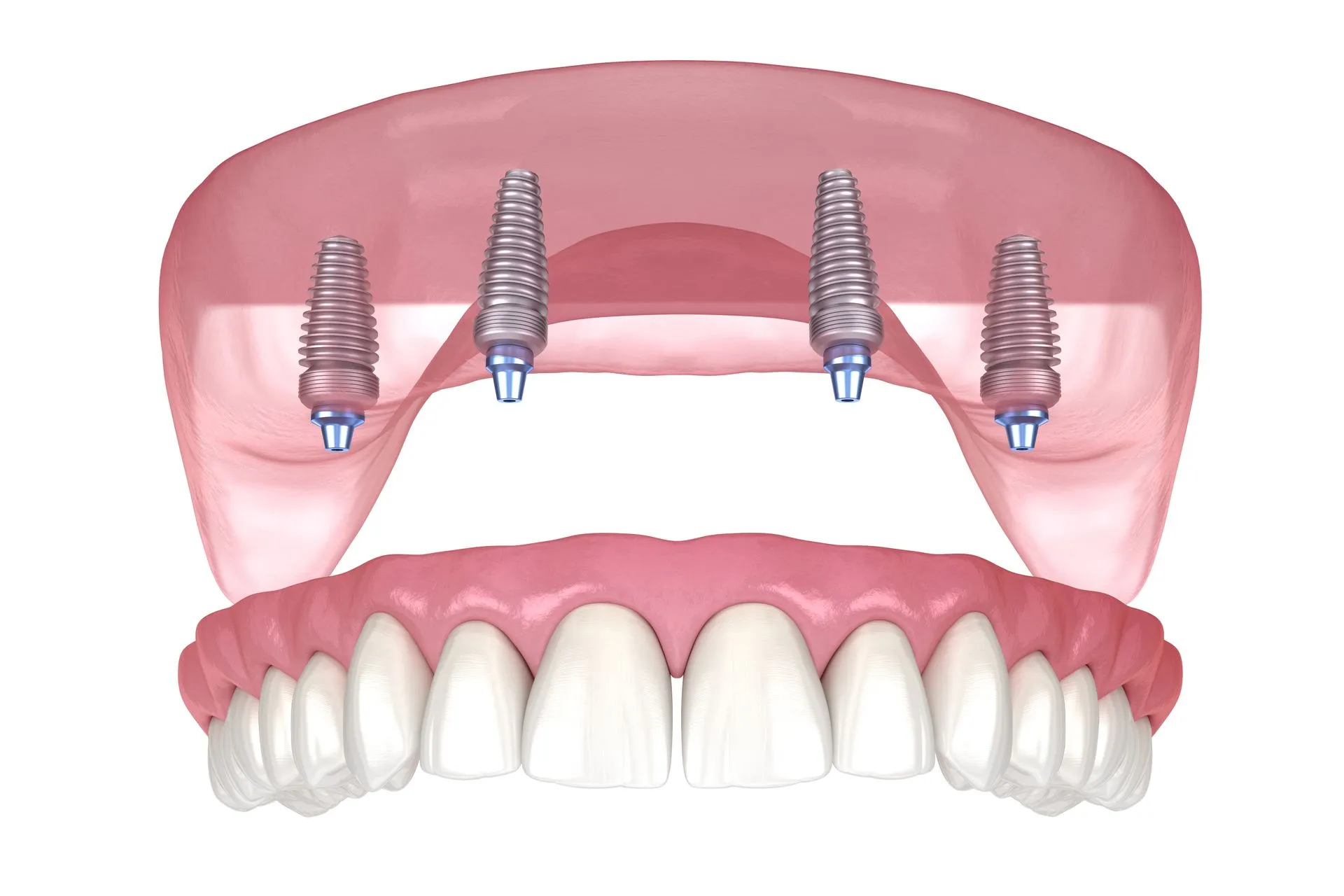 Dental implant treatment planning